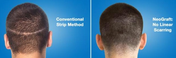 FUE NeoGraft vs Traditional Strip Hair Transplant